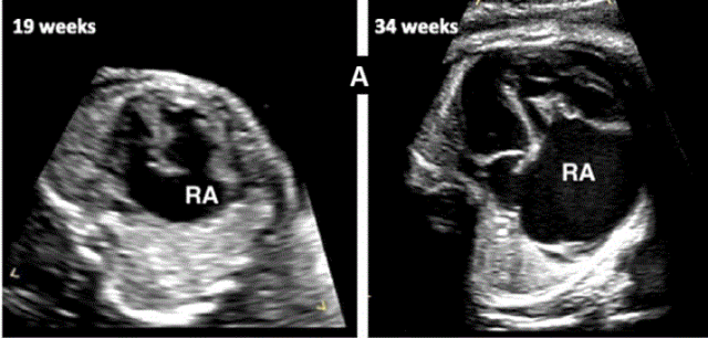 胎儿mt是什么检查什么疼吗ASE胎儿超声心动图检查指南及建议（更新）IV. 针对特定疾病的解剖、生理和功能胎儿超声心动图评估指南-C.结构性心脏病-iv_https://www.jmylbn.com_新闻资讯_第11张