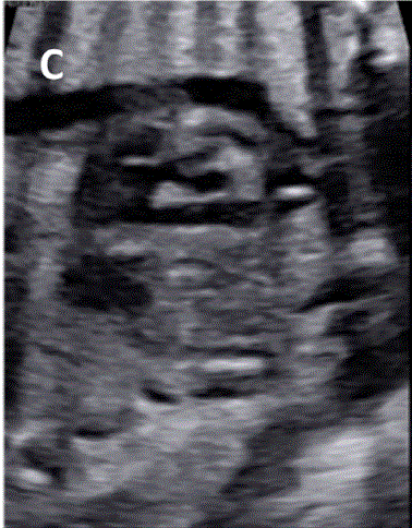 胎儿mt是什么检查什么疼吗ASE胎儿超声心动图检查指南及建议（更新）IV. 针对特定疾病的解剖、生理和功能胎儿超声心动图评估指南-C.结构性心脏病-iv_https://www.jmylbn.com_新闻资讯_第8张