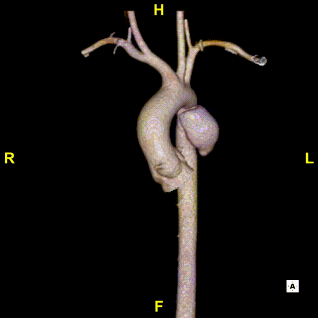 gore医疗怎么样「胸有乾坤」仁心仁术 精益求精——GORE® TAG® 可主动调控胸主动脉覆膜支架治疗15岁患者外伤后夹层病例报道_https://www.jmylbn.com_新闻资讯_第7张