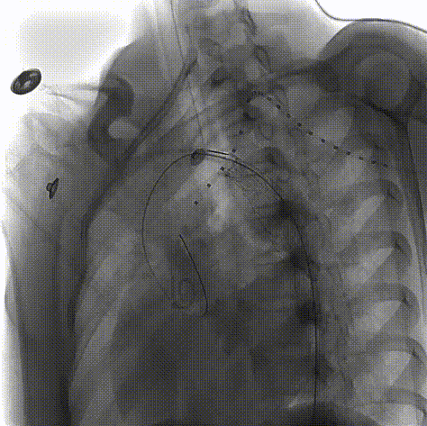 gore医疗怎么样「胸有乾坤」仁心仁术 精益求精——GORE® TAG® 可主动调控胸主动脉覆膜支架治疗15岁患者外伤后夹层病例报道_https://www.jmylbn.com_新闻资讯_第12张