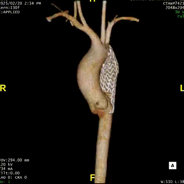 gore医疗怎么样「胸有乾坤」仁心仁术 精益求精——GORE® TAG® 可主动调控胸主动脉覆膜支架治疗15岁患者外伤后夹层病例报道_https://www.jmylbn.com_新闻资讯_第15张