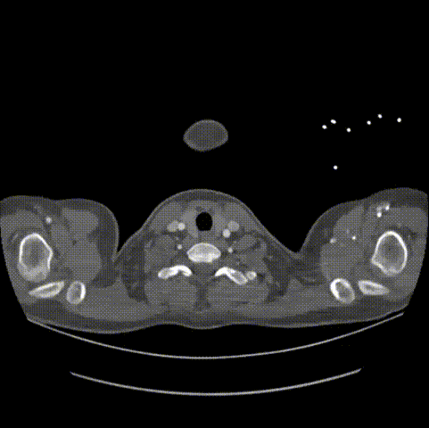 gore医疗怎么样「胸有乾坤」仁心仁术 精益求精——GORE® TAG® 可主动调控胸主动脉覆膜支架治疗15岁患者外伤后夹层病例报道_https://www.jmylbn.com_新闻资讯_第6张