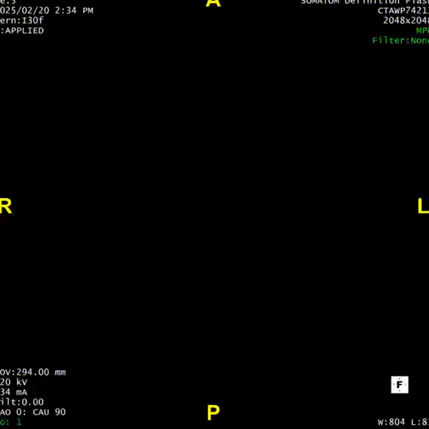 gore医疗怎么样「胸有乾坤」仁心仁术 精益求精——GORE® TAG® 可主动调控胸主动脉覆膜支架治疗15岁患者外伤后夹层病例报道_https://www.jmylbn.com_新闻资讯_第14张