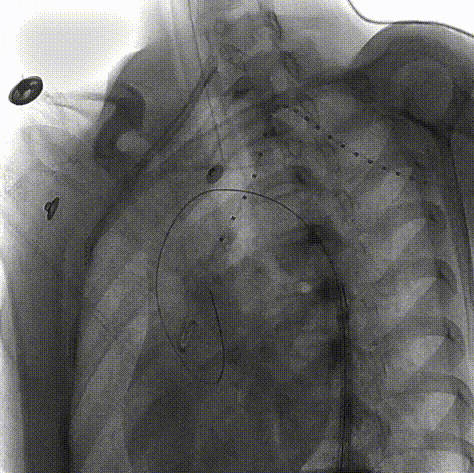 gore医疗怎么样「胸有乾坤」仁心仁术 精益求精——GORE® TAG® 可主动调控胸主动脉覆膜支架治疗15岁患者外伤后夹层病例报道_https://www.jmylbn.com_新闻资讯_第11张