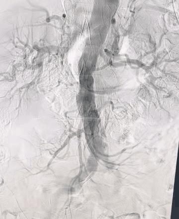 动脉长鞘怎么置入桡胜一筹丨吴巍巍主任、赵俊来教授团队：应用Brite Tip RADIANZ长鞘经桡动脉治疗下肢动脉粥样硬化闭塞症一例_https://www.jmylbn.com_新闻资讯_第15张