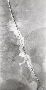 动脉长鞘怎么置入桡胜一筹丨吴巍巍主任、赵俊来教授团队：应用Brite Tip RADIANZ长鞘经桡动脉治疗下肢动脉粥样硬化闭塞症一例_https://www.jmylbn.com_新闻资讯_第20张