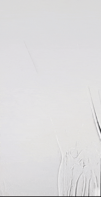 动脉长鞘怎么置入桡胜一筹丨吴巍巍主任、赵俊来教授团队：应用Brite Tip RADIANZ长鞘经桡动脉治疗下肢动脉粥样硬化闭塞症一例_https://www.jmylbn.com_新闻资讯_第22张