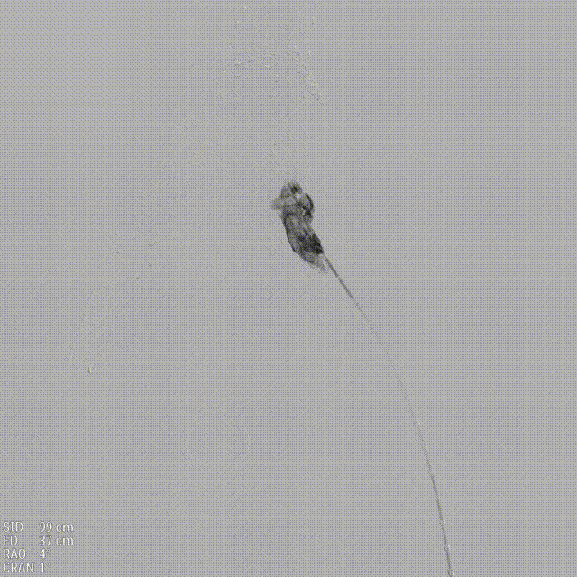 gore医疗怎么样「漫腹精论」独具匠心 推陈出新——同侧IBE支架内翻山重建髂内动脉治疗EVAR术后内漏病例报道_https://www.jmylbn.com_新闻资讯_第22张