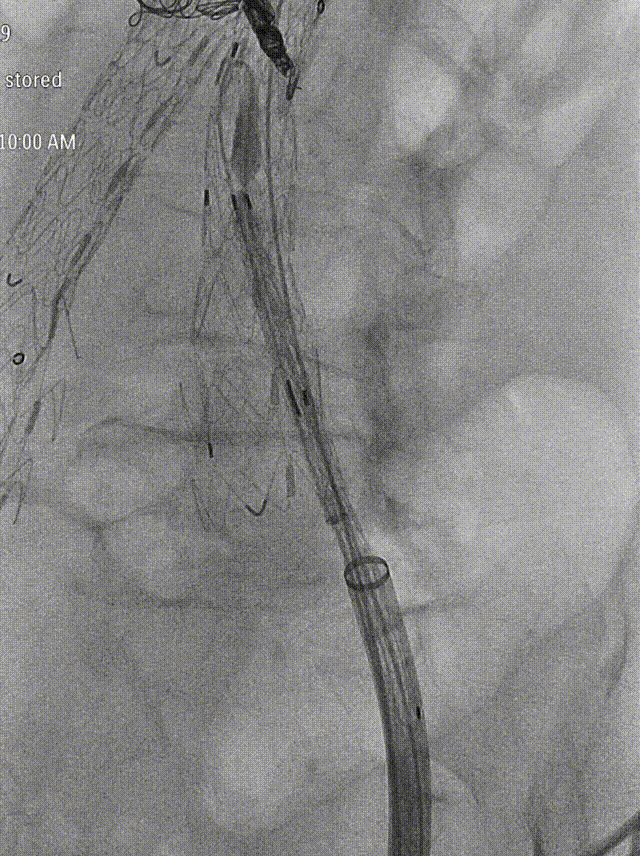 gore医疗怎么样「漫腹精论」独具匠心 推陈出新——同侧IBE支架内翻山重建髂内动脉治疗EVAR术后内漏病例报道_https://www.jmylbn.com_新闻资讯_第14张