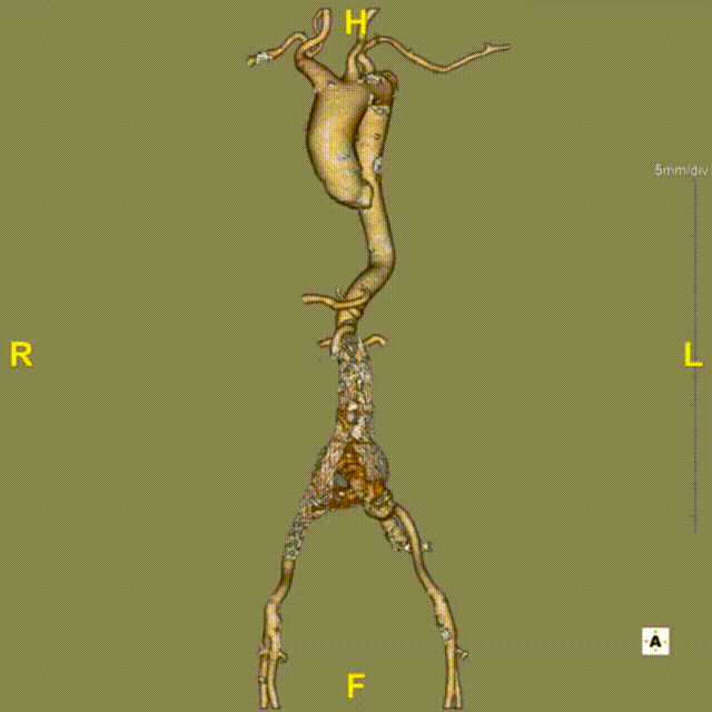 gore医疗怎么样「漫腹精论」独具匠心 推陈出新——同侧IBE支架内翻山重建髂内动脉治疗EVAR术后内漏病例报道_https://www.jmylbn.com_新闻资讯_第7张
