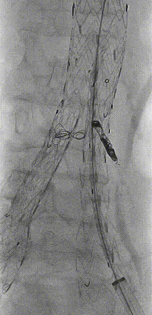 gore医疗怎么样「漫腹精论」独具匠心 推陈出新——同侧IBE支架内翻山重建髂内动脉治疗EVAR术后内漏病例报道_https://www.jmylbn.com_新闻资讯_第13张