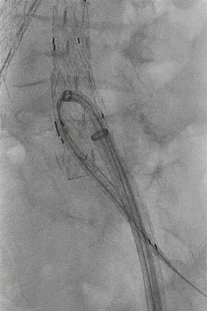 gore医疗怎么样「漫腹精论」独具匠心 推陈出新——同侧IBE支架内翻山重建髂内动脉治疗EVAR术后内漏病例报道_https://www.jmylbn.com_新闻资讯_第19张