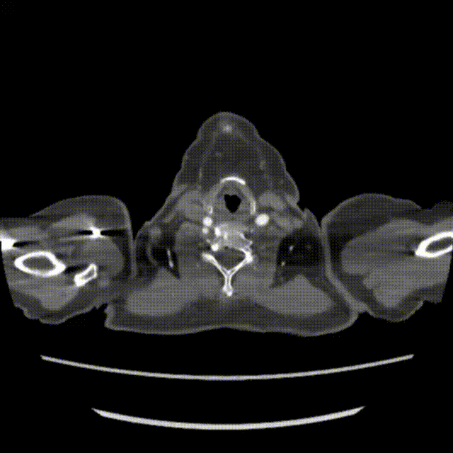 gore医疗怎么样「漫腹精论」独具匠心 推陈出新——同侧IBE支架内翻山重建髂内动脉治疗EVAR术后内漏病例报道_https://www.jmylbn.com_新闻资讯_第6张