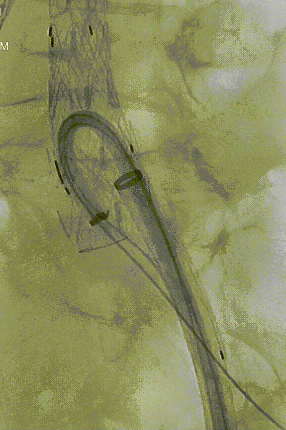 gore医疗怎么样「漫腹精论」独具匠心 推陈出新——同侧IBE支架内翻山重建髂内动脉治疗EVAR术后内漏病例报道_https://www.jmylbn.com_新闻资讯_第18张