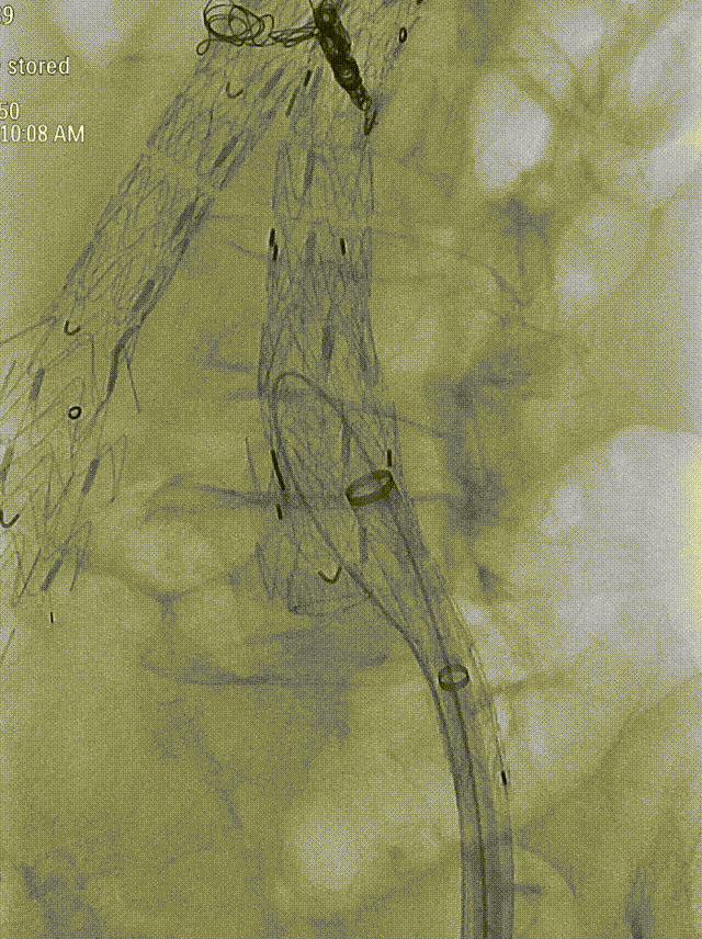 gore医疗怎么样「漫腹精论」独具匠心 推陈出新——同侧IBE支架内翻山重建髂内动脉治疗EVAR术后内漏病例报道_https://www.jmylbn.com_新闻资讯_第16张