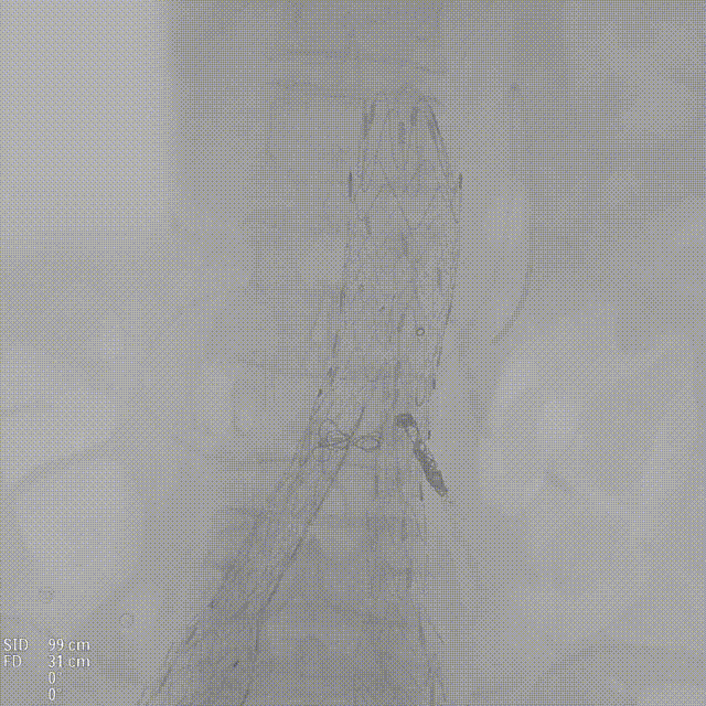 gore医疗怎么样「漫腹精论」独具匠心 推陈出新——同侧IBE支架内翻山重建髂内动脉治疗EVAR术后内漏病例报道_https://www.jmylbn.com_新闻资讯_第12张