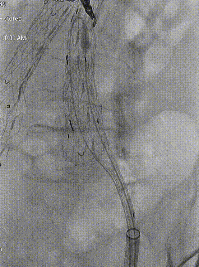 gore医疗怎么样「漫腹精论」独具匠心 推陈出新——同侧IBE支架内翻山重建髂内动脉治疗EVAR术后内漏病例报道_https://www.jmylbn.com_新闻资讯_第15张