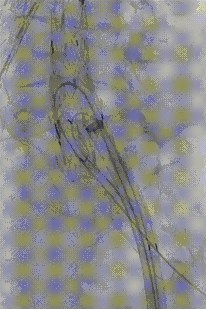 gore医疗怎么样「漫腹精论」独具匠心 推陈出新——同侧IBE支架内翻山重建髂内动脉治疗EVAR术后内漏病例报道_https://www.jmylbn.com_新闻资讯_第20张