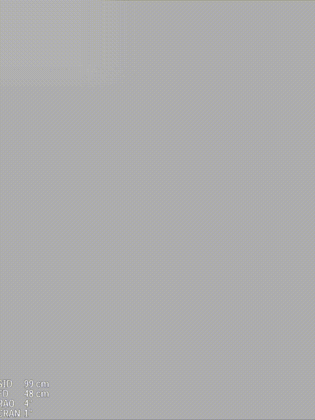 gore医疗怎么样「漫腹精论」独具匠心 推陈出新——同侧IBE支架内翻山重建髂内动脉治疗EVAR术后内漏病例报道_https://www.jmylbn.com_新闻资讯_第21张