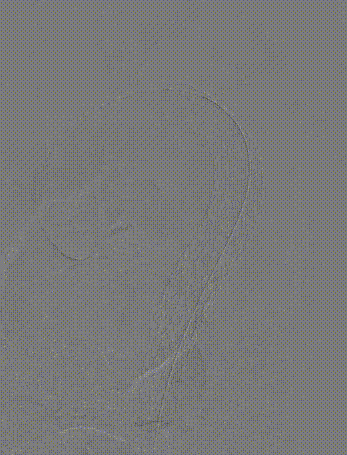 gore医疗怎么样「胸有乾坤」可调可控 遂心应手——GORE® TAG® 可主动调控胸主动脉覆膜支架治疗急性夹层病例报道_https://www.jmylbn.com_新闻资讯_第15张