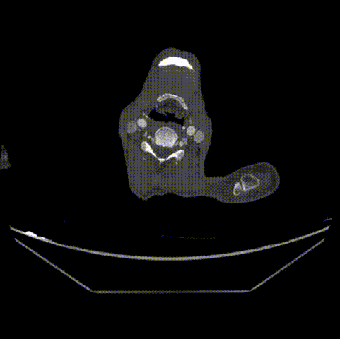 gore医疗怎么样「胸有乾坤」可调可控 遂心应手——GORE® TAG® 可主动调控胸主动脉覆膜支架治疗急性夹层病例报道_https://www.jmylbn.com_新闻资讯_第6张