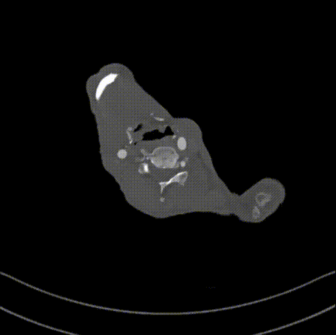 gore医疗怎么样「胸有乾坤」可调可控 遂心应手——GORE® TAG® 可主动调控胸主动脉覆膜支架治疗急性夹层病例报道_https://www.jmylbn.com_新闻资讯_第16张