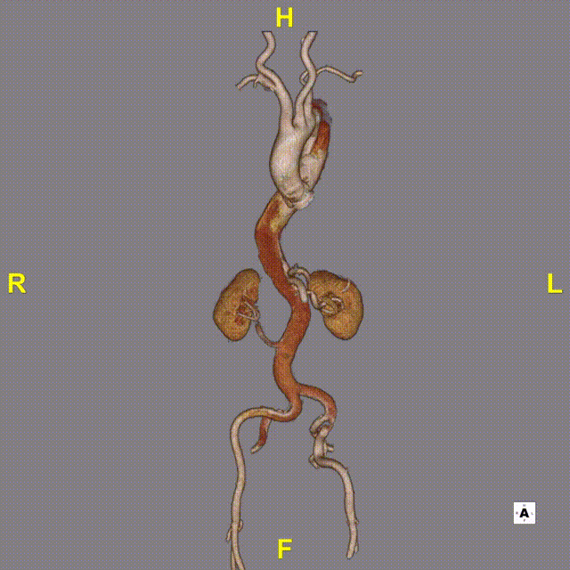 gore医疗怎么样「胸有乾坤」可调可控 遂心应手——GORE® TAG® 可主动调控胸主动脉覆膜支架治疗急性夹层病例报道_https://www.jmylbn.com_新闻资讯_第7张