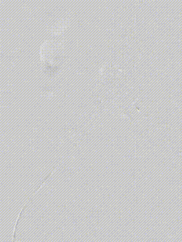 gore医疗怎么样【膜Shu前沿】精准封堵——GORE VBX球囊扩张覆膜支架联合弹簧圈治疗髂内动脉瘤_https://www.jmylbn.com_新闻资讯_第4张