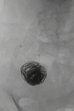 gore医疗怎么样【膜Shu前沿】精准封堵——GORE VBX球囊扩张覆膜支架联合弹簧圈治疗髂内动脉瘤_https://www.jmylbn.com_新闻资讯_第6张