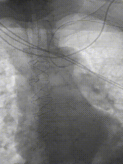 gore医疗怎么样【膜Shu前沿】精准封堵——GORE VBX球囊扩张覆膜支架联合弹簧圈治疗髂内动脉瘤_https://www.jmylbn.com_新闻资讯_第3张