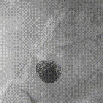 gore医疗怎么样【膜Shu前沿】精准封堵——GORE VBX球囊扩张覆膜支架联合弹簧圈治疗髂内动脉瘤_https://www.jmylbn.com_新闻资讯_第7张