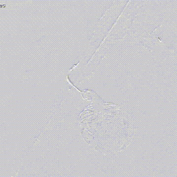 gore医疗怎么样【膜Shu前沿】精准封堵——GORE VBX球囊扩张覆膜支架联合弹簧圈治疗髂内动脉瘤_https://www.jmylbn.com_新闻资讯_第11张