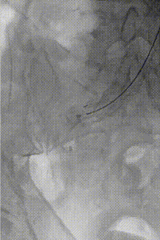 gore医疗怎么样【膜Shu前沿】精准封堵——GORE VBX球囊扩张覆膜支架联合弹簧圈治疗髂内动脉瘤_https://www.jmylbn.com_新闻资讯_第5张