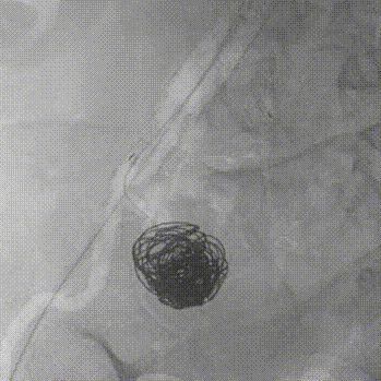 gore医疗怎么样【膜Shu前沿】精准封堵——GORE VBX球囊扩张覆膜支架联合弹簧圈治疗髂内动脉瘤_https://www.jmylbn.com_新闻资讯_第8张