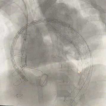gore医疗怎么样「胸有乾坤」强弓硬弩 一蹴而就——CTAG弓上三开窗治疗主动脉夹层病例报道_https://www.jmylbn.com_新闻资讯_第10张
