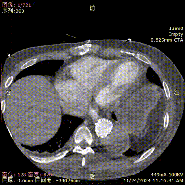 gore医疗怎么样「胸有乾坤」强弓硬弩 一蹴而就——CTAG弓上三开窗治疗主动脉夹层病例报道_https://www.jmylbn.com_新闻资讯_第18张