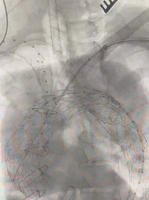 gore医疗怎么样「胸有乾坤」强弓硬弩 一蹴而就——CTAG弓上三开窗治疗主动脉夹层病例报道_https://www.jmylbn.com_新闻资讯_第14张