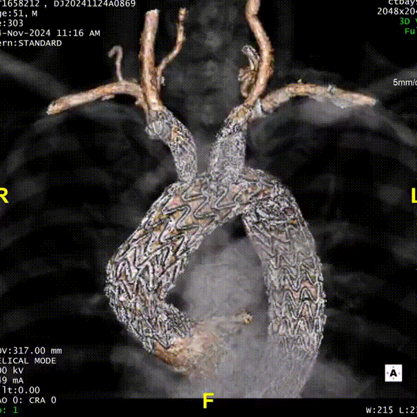 gore医疗怎么样「胸有乾坤」强弓硬弩 一蹴而就——CTAG弓上三开窗治疗主动脉夹层病例报道_https://www.jmylbn.com_新闻资讯_第19张