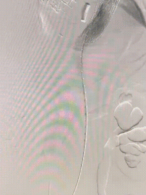 gore医疗怎么样「胸有乾坤」强弓硬弩 一蹴而就——CTAG弓上三开窗治疗主动脉夹层病例报道_https://www.jmylbn.com_新闻资讯_第17张