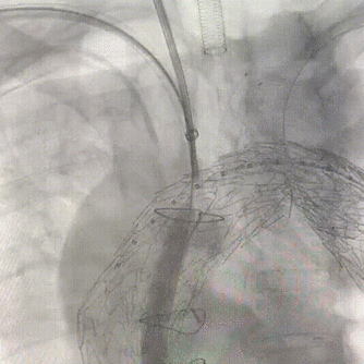 gore医疗怎么样「胸有乾坤」强弓硬弩 一蹴而就——CTAG弓上三开窗治疗主动脉夹层病例报道_https://www.jmylbn.com_新闻资讯_第13张