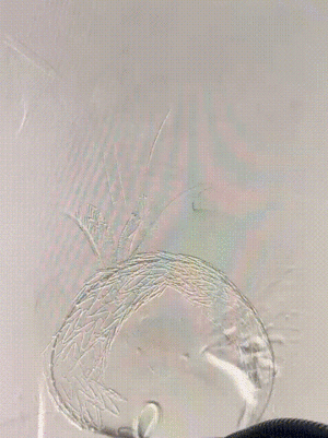 gore医疗怎么样「胸有乾坤」强弓硬弩 一蹴而就——CTAG弓上三开窗治疗主动脉夹层病例报道_https://www.jmylbn.com_新闻资讯_第16张