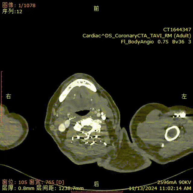 gore医疗怎么样「胸有乾坤」强弓硬弩 一蹴而就——CTAG弓上三开窗治疗主动脉夹层病例报道_https://www.jmylbn.com_新闻资讯_第6张