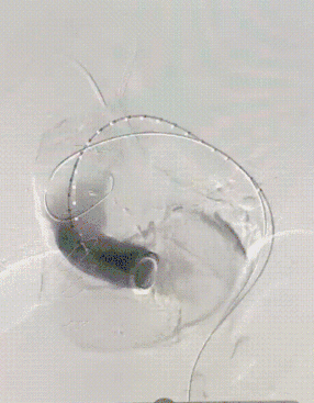 gore医疗怎么样「胸有乾坤」强弓硬弩 一蹴而就——CTAG弓上三开窗治疗主动脉夹层病例报道_https://www.jmylbn.com_新闻资讯_第8张