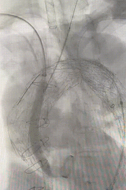 gore医疗怎么样「胸有乾坤」强弓硬弩 一蹴而就——CTAG弓上三开窗治疗主动脉夹层病例报道_https://www.jmylbn.com_新闻资讯_第12张