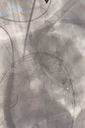 gore医疗怎么样「胸有乾坤」强弓硬弩 一蹴而就——CTAG弓上三开窗治疗主动脉夹层病例报道_https://www.jmylbn.com_新闻资讯_第11张