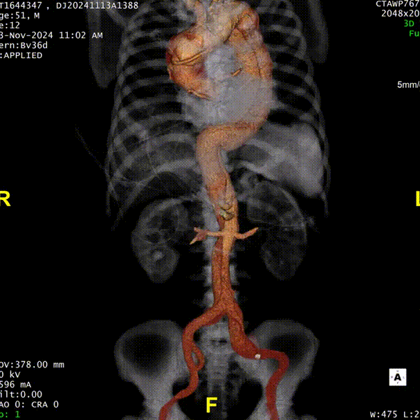 gore医疗怎么样「胸有乾坤」强弓硬弩 一蹴而就——CTAG弓上三开窗治疗主动脉夹层病例报道_https://www.jmylbn.com_新闻资讯_第7张