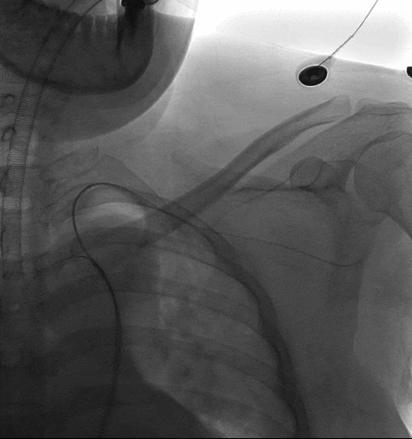 动脉长鞘怎么置入宁波市第二医院血管外科运用Castor®单分支支架结合长鞘建立导丝通路的方法治疗Stanford B型胸主动脉夹层一例_https://www.jmylbn.com_新闻资讯_第6张