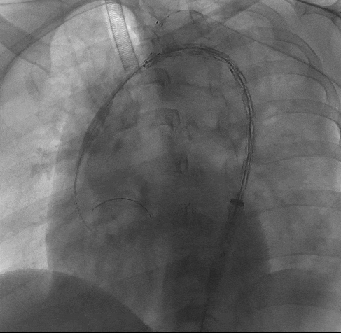 动脉长鞘怎么置入宁波市第二医院血管外科运用Castor®单分支支架结合长鞘建立导丝通路的方法治疗Stanford B型胸主动脉夹层一例_https://www.jmylbn.com_新闻资讯_第9张