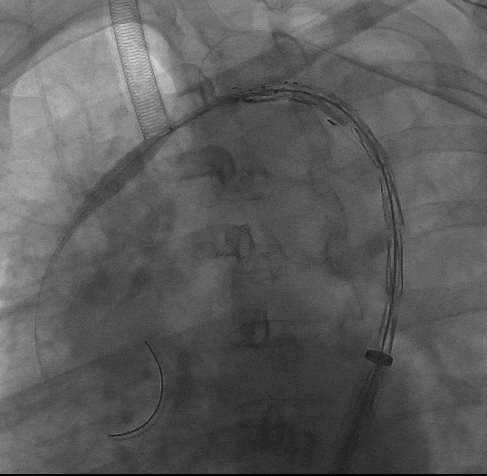 动脉长鞘怎么置入宁波市第二医院血管外科运用Castor®单分支支架结合长鞘建立导丝通路的方法治疗Stanford B型胸主动脉夹层一例_https://www.jmylbn.com_新闻资讯_第8张