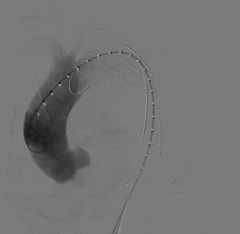 动脉长鞘怎么置入宁波市第二医院血管外科运用Castor®单分支支架结合长鞘建立导丝通路的方法治疗Stanford B型胸主动脉夹层一例_https://www.jmylbn.com_新闻资讯_第12张